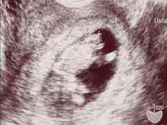 妊娠10週の胎児の様子