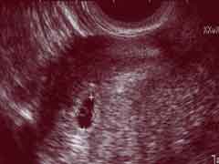 妊娠4週の胎児の様子