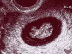 妊娠8週の胎児の様子