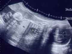 妊娠32週の胎児の様子