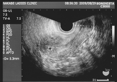 妊娠1ヶ月 妊娠4週目 胎嚢 超音波写真