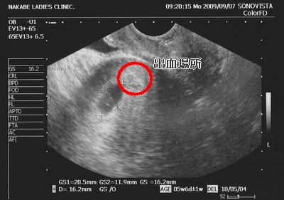 妊娠2ヶ月 妊娠5週目 胎嚢 超音波写真