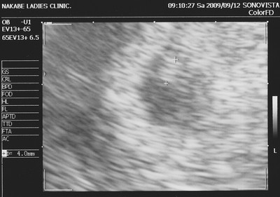 妊娠2ヶ月 妊娠6週目 胎嚢 超音波写真
