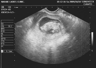 妊娠3ヶ月 妊娠10週目 頚部浮腫 むくみ 超音波写真