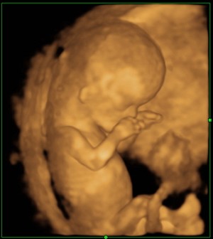 妊娠3ヶ月 妊娠11週目 3D 4D 超音波写真