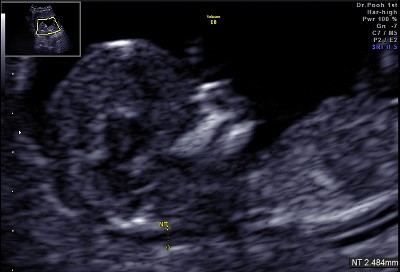 妊娠3ヶ月 妊娠11週目 頚部浮腫 超音波写真