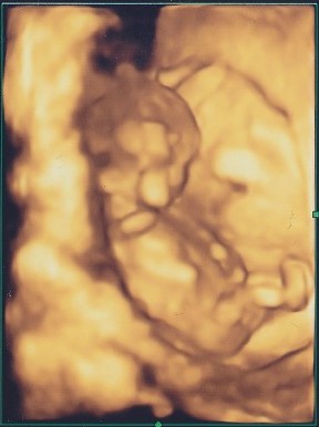 妊娠4ヶ月 妊娠12週目 3D 4D 超音波写真
