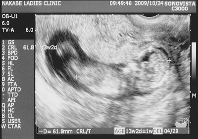 妊娠4ヶ月 妊娠13週目 超音波写真