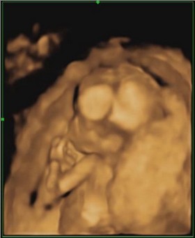 妊娠4ヶ月 妊娠15週目 超音波 4D 写真