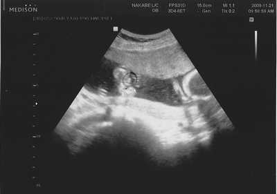 妊娠5ヶ月 妊娠17週目 超音波 性別 写真
