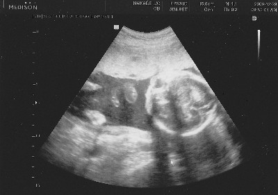 妊娠6ヶ月 妊娠22週目 超音波 胎児 写真