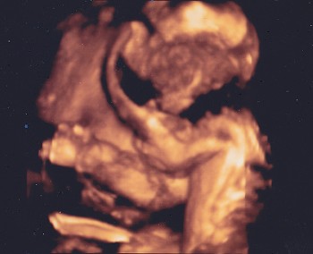 妊娠7ヶ月 妊娠26週目 超音波 胎児 写真 3D