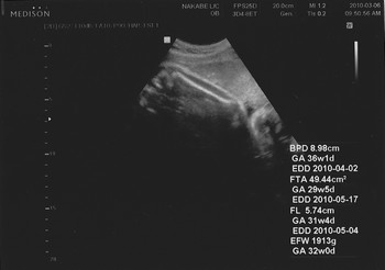 妊娠8ヶ月 妊娠31週目 超音波 胎児 写真
