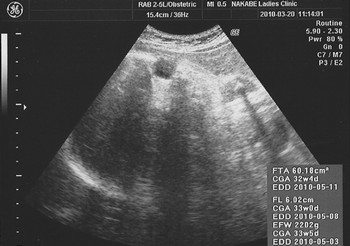妊娠9ヶ月 妊娠33週目 超音波 胎児 写真
