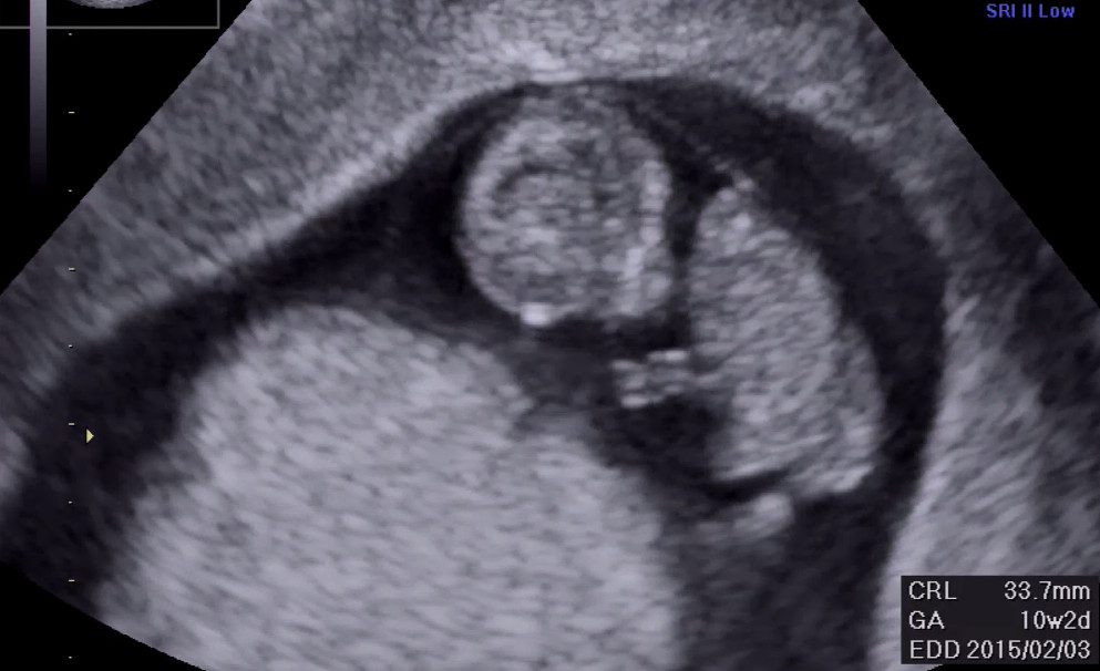 妊娠9週6日目の胎児