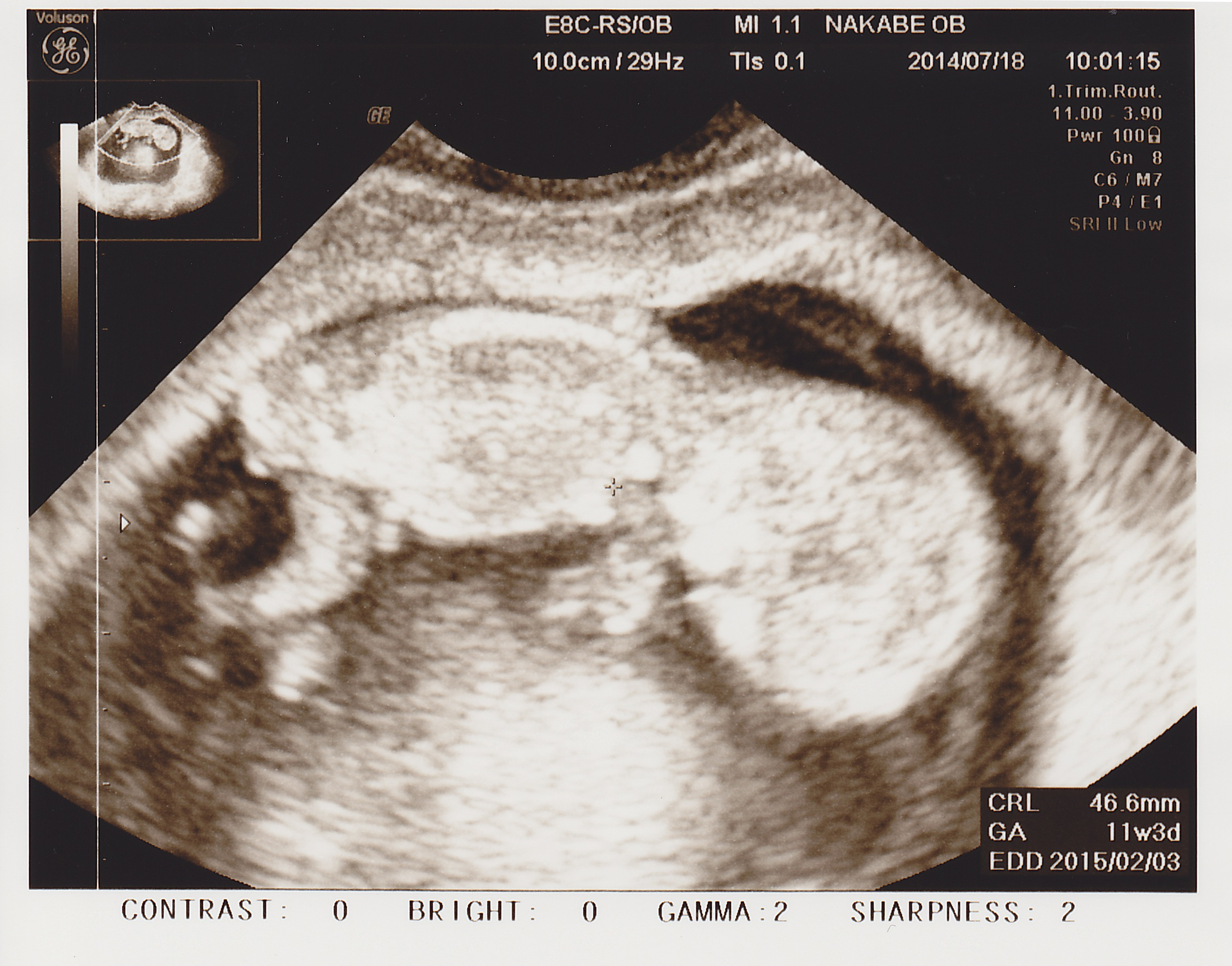 妊娠11週 子宮がん検診 クラス3a