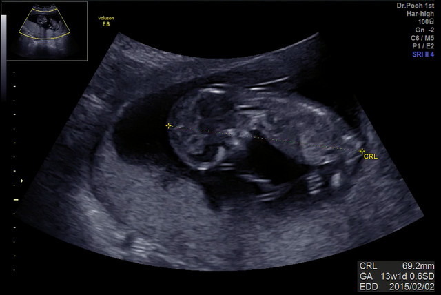 クリフム 初期胎児ドッグ 絨毛検査 QF-PCR