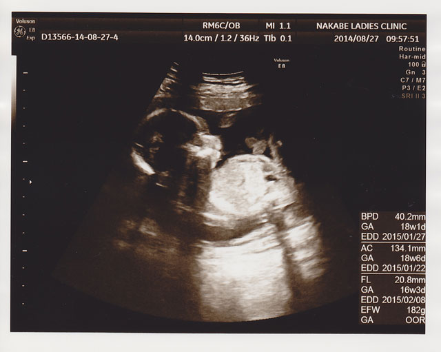 妊娠中期 5ヵ月 16週 エコー