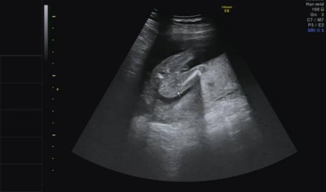 妊娠中期 5ヵ月 16週 エコー 性別