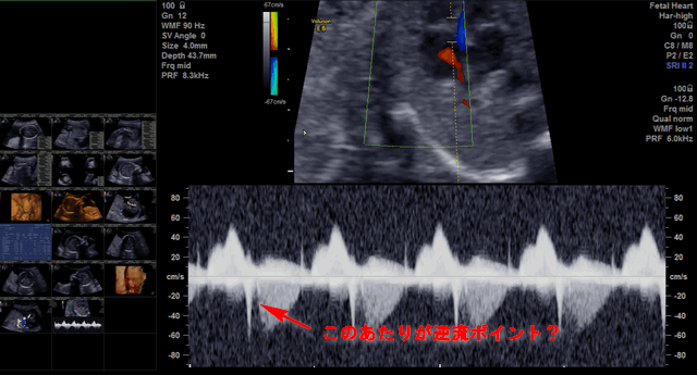 妊娠中期 5ヵ月 三尖弁逆流