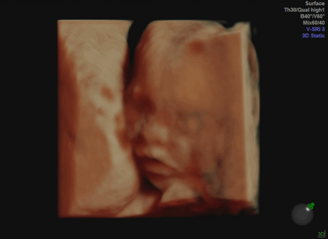 妊娠中期 5ヵ月 3D画像