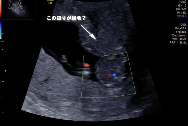 クリフムで初期胎児ドッグ 絨毛検査：妊娠4ヵ月(妊娠12週目)：